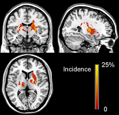 Enhanced Effective Connectivity From Ipsilesional to Contralesional M1 in Well-Recovered Subcortical Stroke Patients